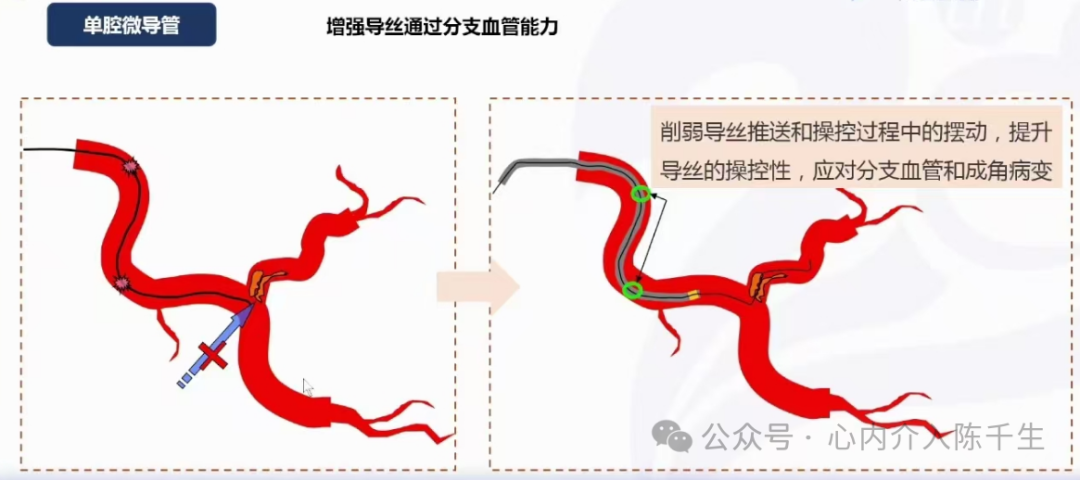 冠状动脉慢性完全闭塞病变介入治疗学习笔记：微导管的选择和操作技术