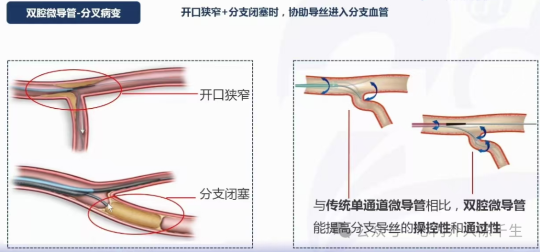 冠状动脉慢性完全闭塞病变介入治疗学习笔记：微导管的选择和操作技术