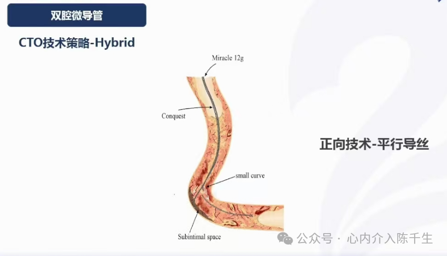 冠状动脉慢性完全闭塞病变介入治疗学习笔记：微导管的选择和操作技术