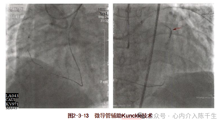 冠状动脉慢性完全闭塞病变介入治疗学习笔记：微导管的选择和操作技术