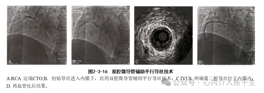 冠状动脉慢性完全闭塞病变介入治疗学习笔记：微导管的选择和操作技术