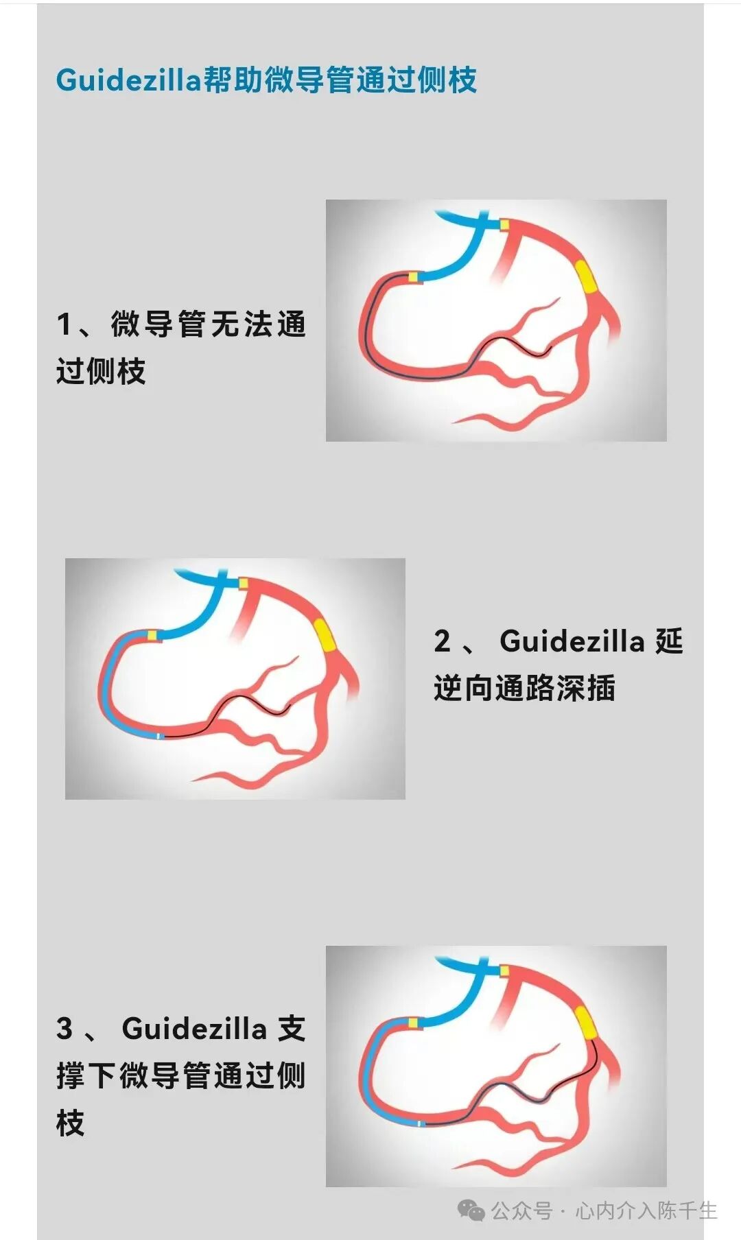 冠状动脉慢性完全闭塞病变介入治疗学习笔记：微导管的选择和操作技术