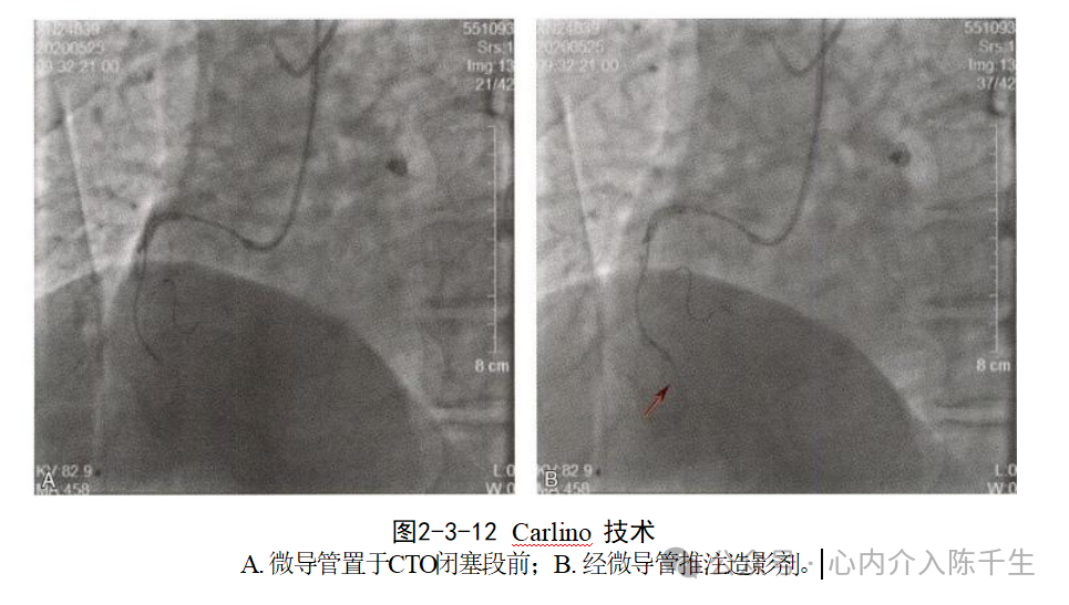 冠状动脉慢性完全闭塞病变介入治疗学习笔记：微导管的选择和操作技术