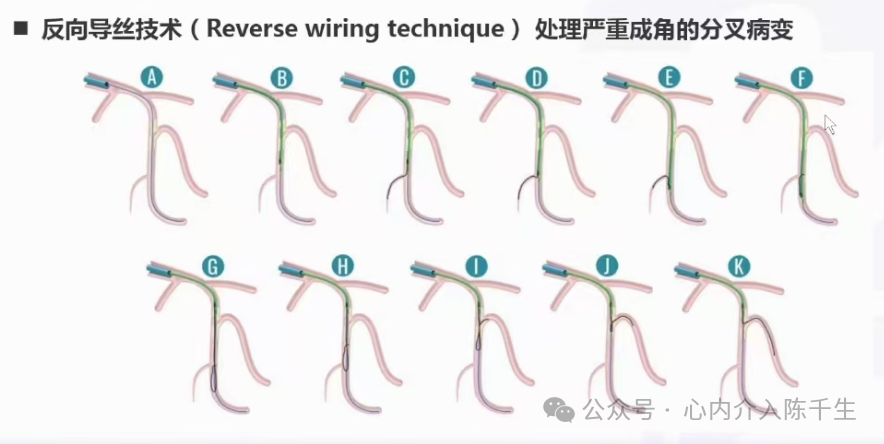 冠状动脉慢性完全闭塞病变介入治疗学习笔记：微导管的选择和操作技术