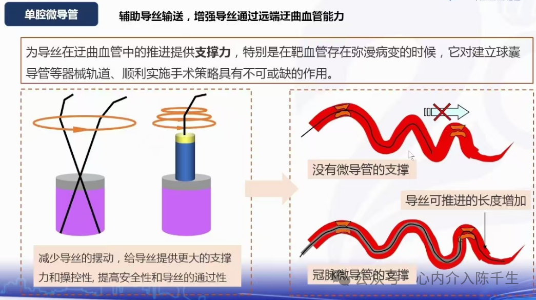 冠状动脉慢性完全闭塞病变介入治疗学习笔记：微导管的选择和操作技术