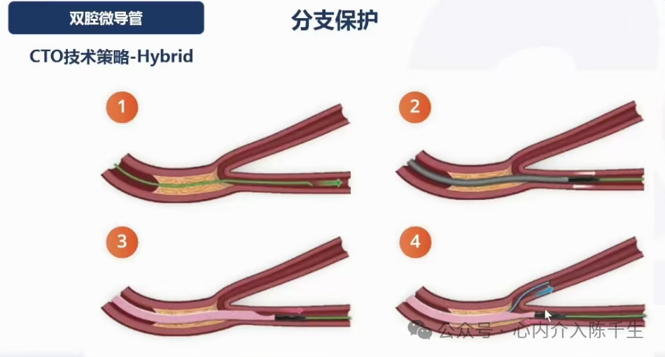 冠状动脉慢性完全闭塞病变介入治疗学习笔记：微导管的选择和操作技术