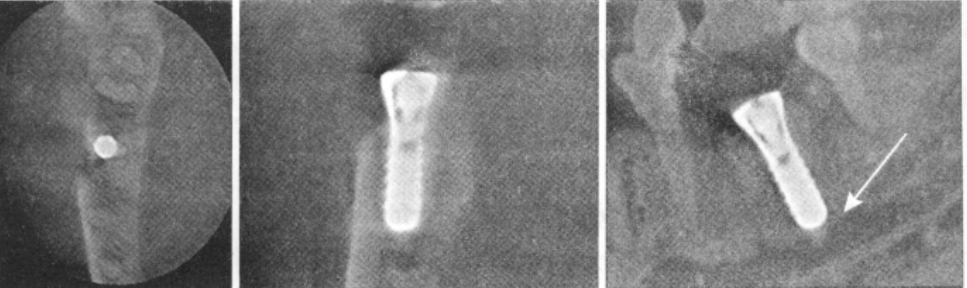 种植体挤压，致骨折片突入下牙槽神经管