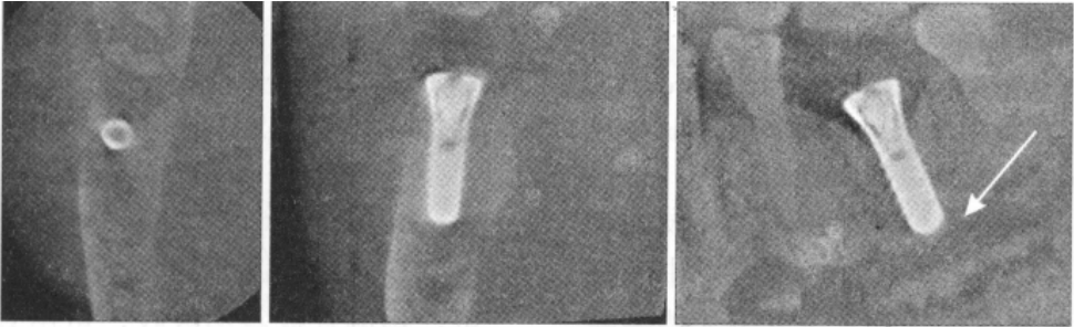种植体挤压，致骨折片突入下牙槽神经管