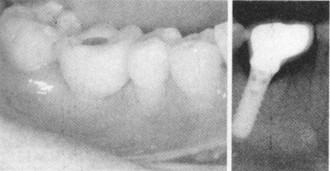 种植体挤压，致骨折片突入下牙槽神经管