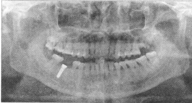 种植体挤压，致骨折片突入下牙槽神经管
