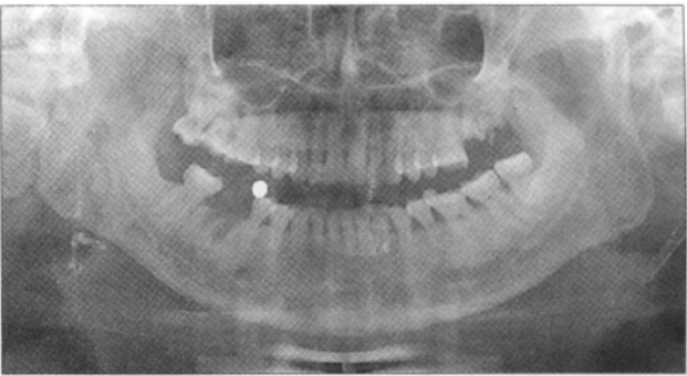 种植体挤压，致骨折片突入下牙槽神经管