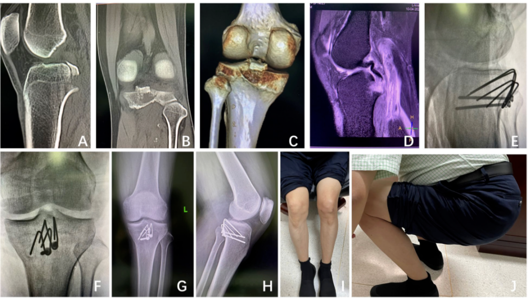 改造克氏针轻松解决后叉止点骨折