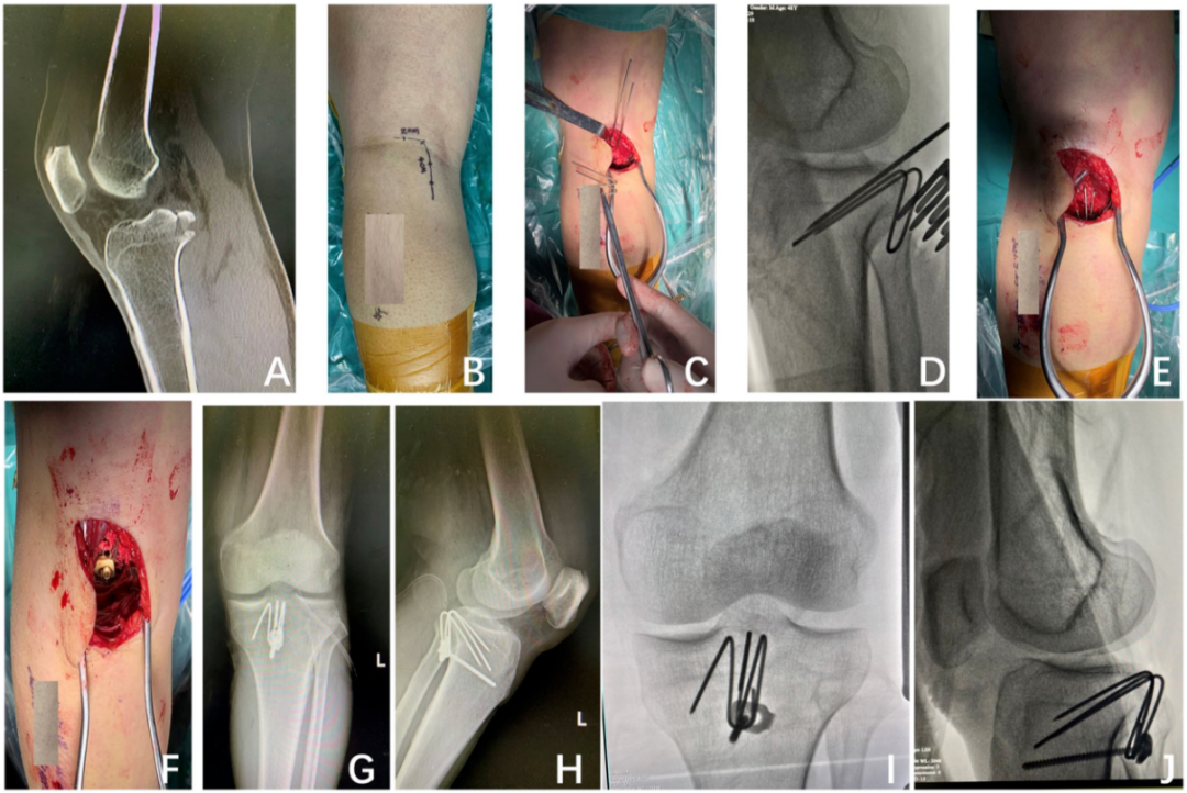 改造克氏针轻松解决后叉止点骨折