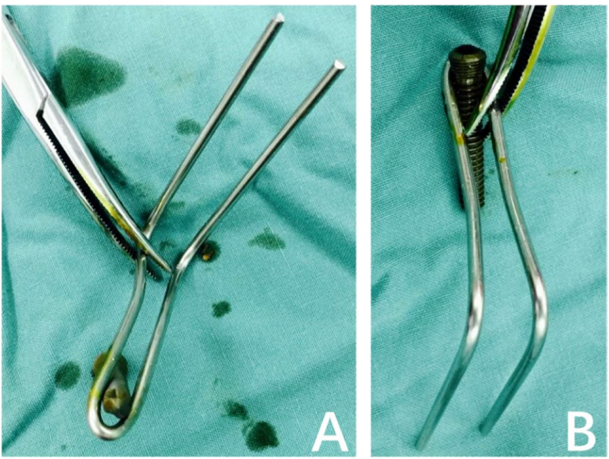 改造克氏针轻松解决后叉止点骨折