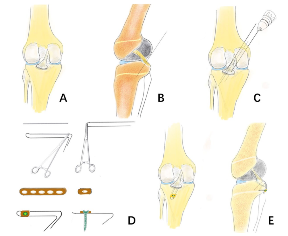 改造克氏针轻松解决后叉止点骨折