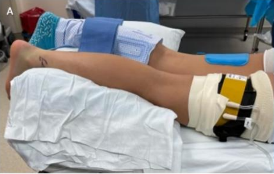 【手术技术】切开修复技术治疗急性跟腱断裂