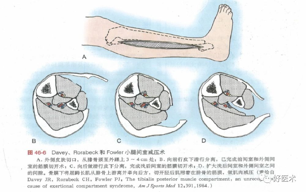 何时清创?如何减少感染?关于开放性骨折,你需要知道的方方面面!