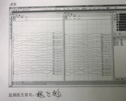 一种较安全的胸椎黄韧带骨化切除技术