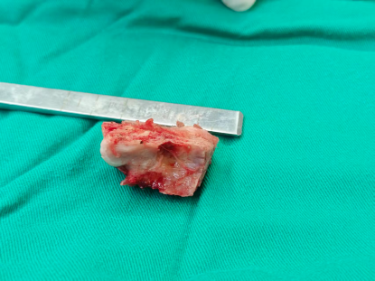 一种较安全的胸椎黄韧带骨化切除技术