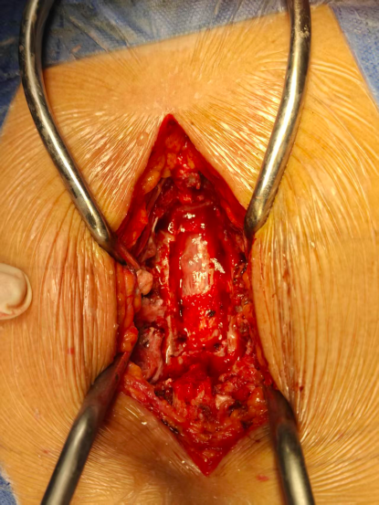 一种较安全的胸椎黄韧带骨化切除技术