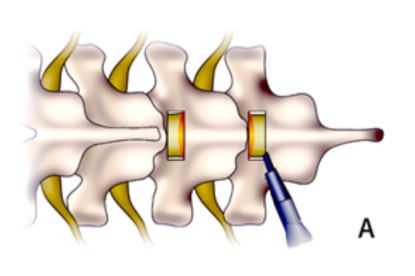一种较安全的胸椎黄韧带骨化切除技术