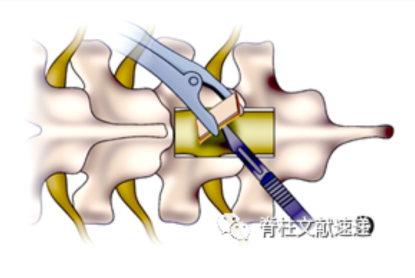 一种较安全的胸椎黄韧带骨化切除技术
