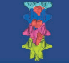 一种较安全的胸椎黄韧带骨化切除技术