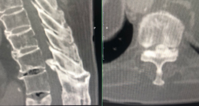 一种较安全的胸椎黄韧带骨化切除技术