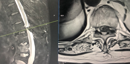 一种较安全的胸椎黄韧带骨化切除技术