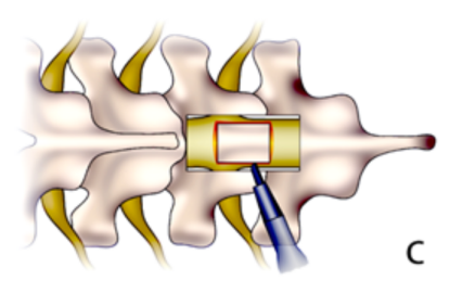 一种较安全的胸椎黄韧带骨化切除技术