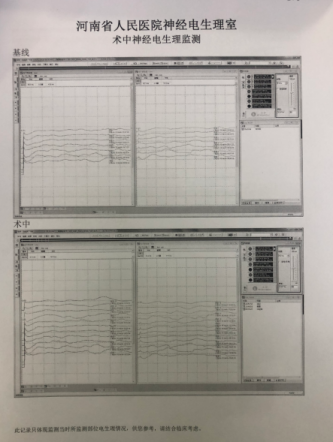 一种较安全的胸椎黄韧带骨化切除技术