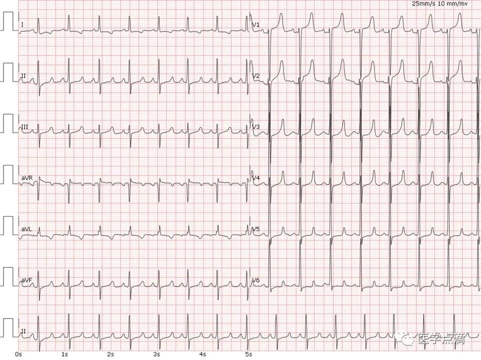 教你用最简单方法学习心电图！