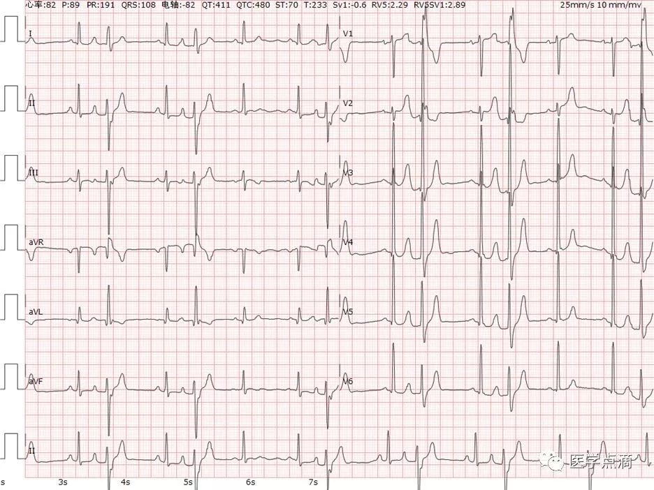 教你用最简单方法学习心电图！