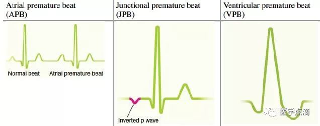 教你用最简单方法学习心电图！