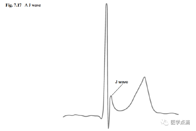 教你用最简单方法学习心电图！