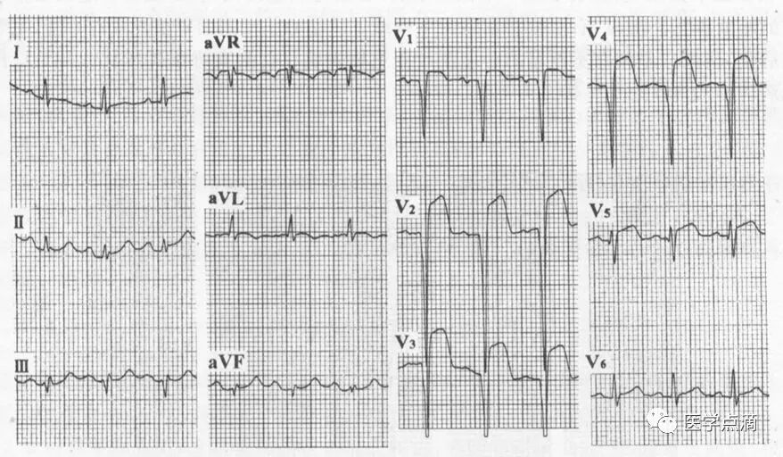 教你用最简单方法学习心电图！