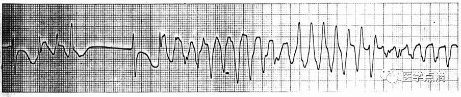 教你用最简单方法学习心电图！