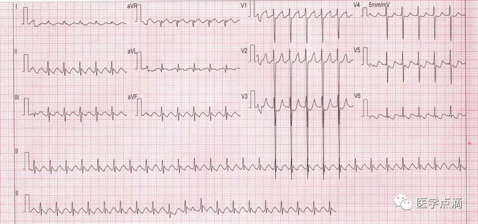 教你用最简单方法学习心电图！