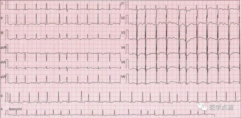 教你用最简单方法学习心电图！