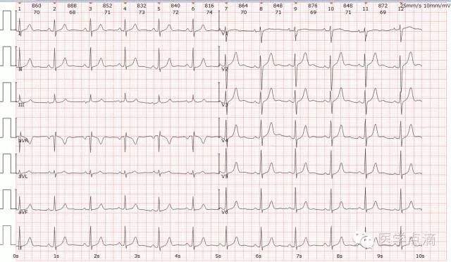 教你用最简单方法学习心电图！