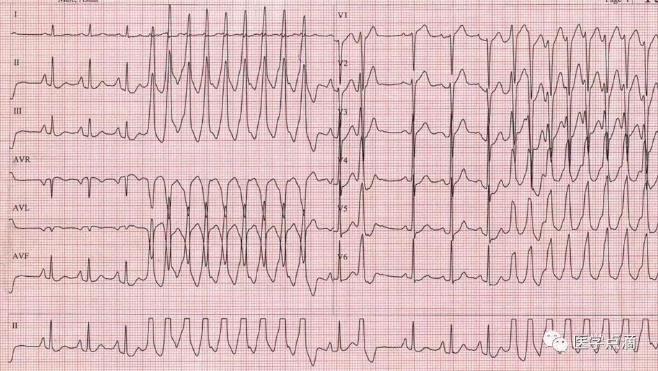 教你用最简单方法学习心电图！