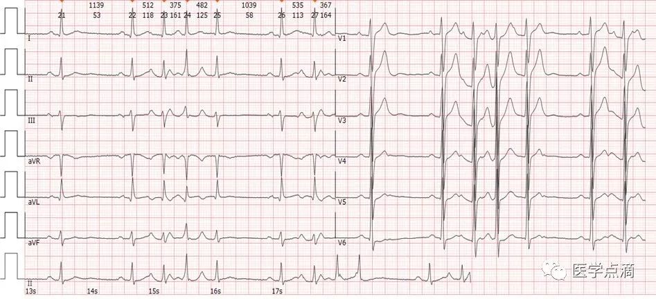 教你用最简单方法学习心电图！