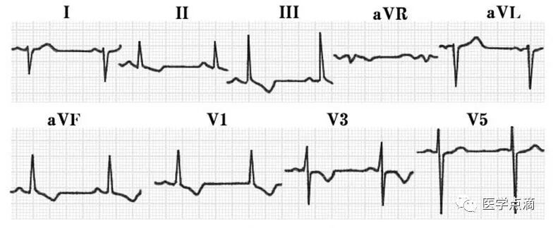 教你用最简单方法学习心电图！