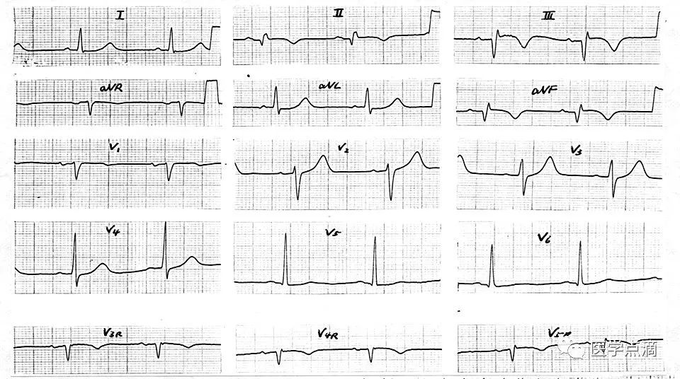 教你用最简单方法学习心电图！