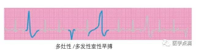 教你用最简单方法学习心电图！