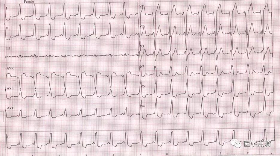 教你用最简单方法学习心电图！