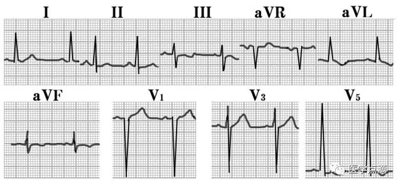 教你用最简单方法学习心电图！