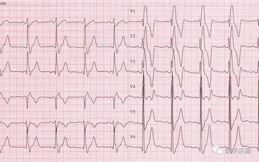教你用最简单方法学习心电图！