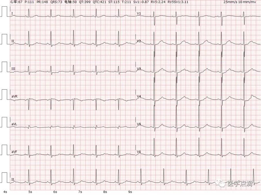 教你用最简单方法学习心电图！