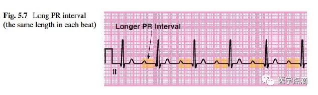 教你用最简单方法学习心电图！